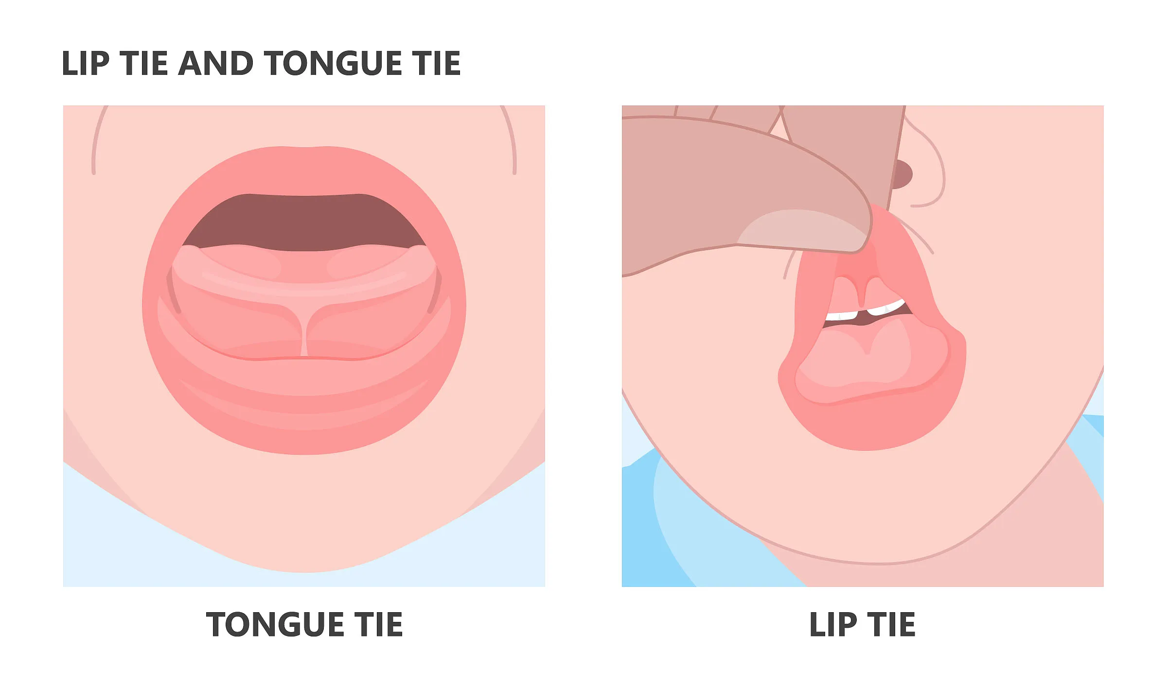 Illustration comparing a tongue tie and a lip tie