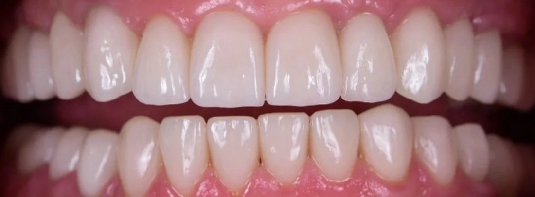 Upper and lower teeth after a full smile restoration