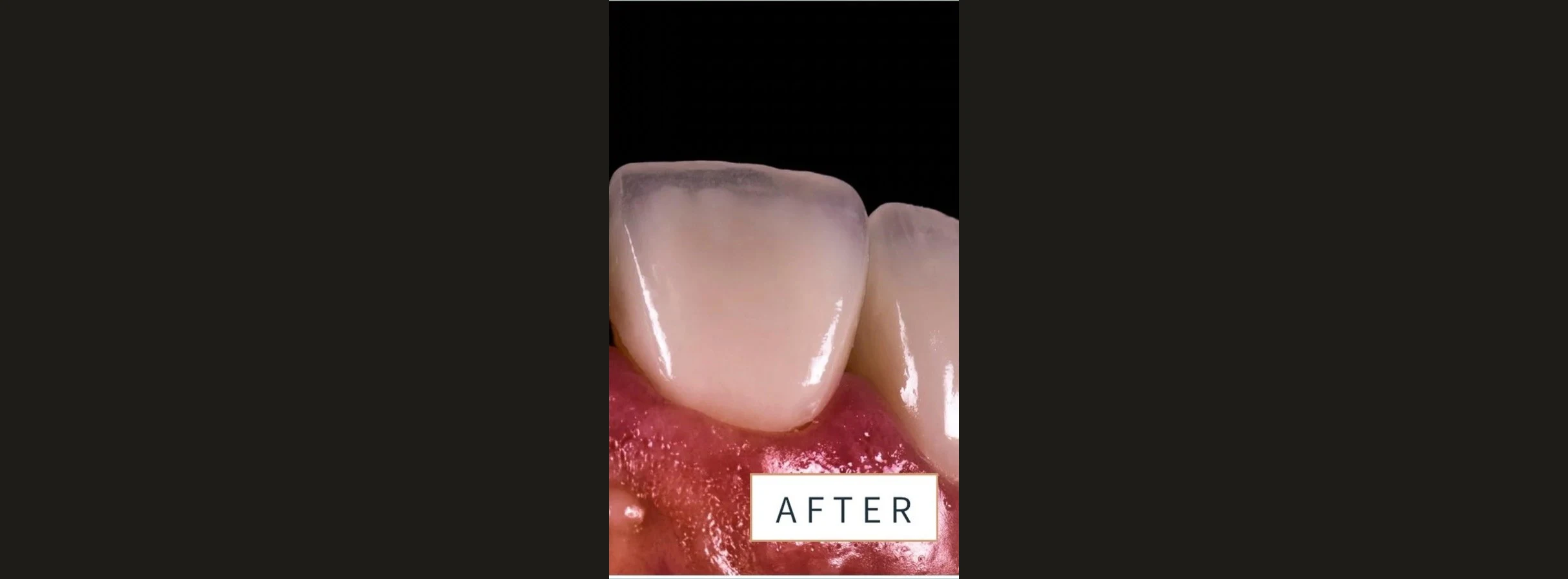 Front tooth after a porcelain crown, labeled after