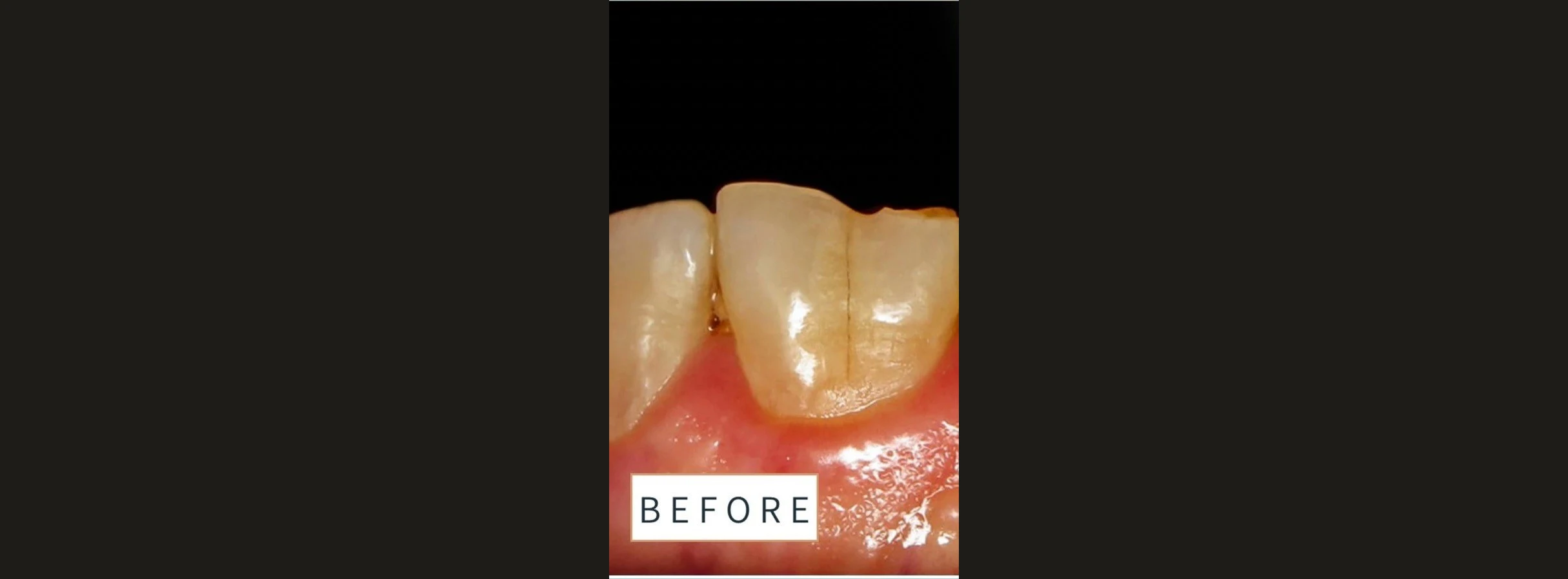 Discolored, cracked front tooth before treatment, labeled before