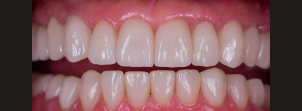 Even, restored upper and lower teeth after treatment