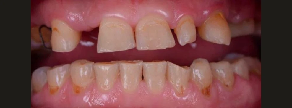 Worn, broken and gapped teeth before treatment