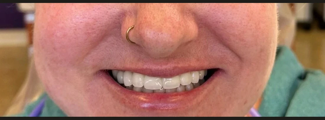 Patient's smile after cosmetic treatment