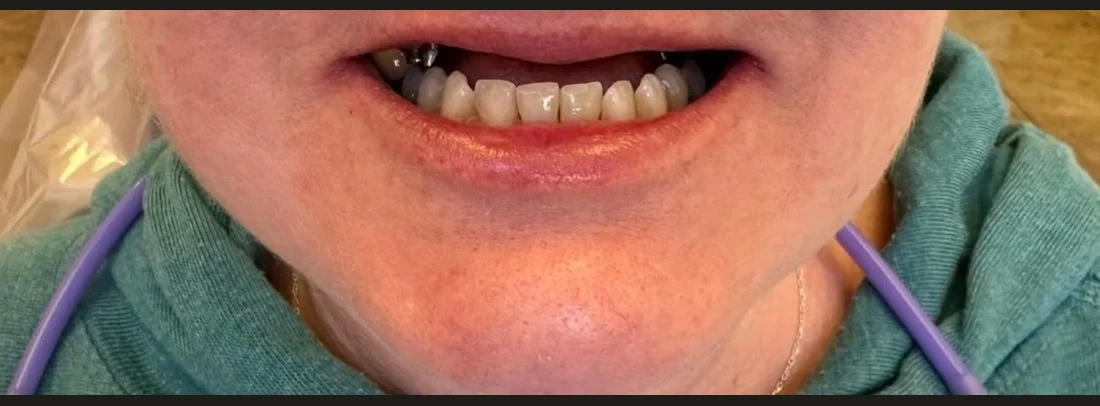 Patient's smile with discolored teeth before treatment