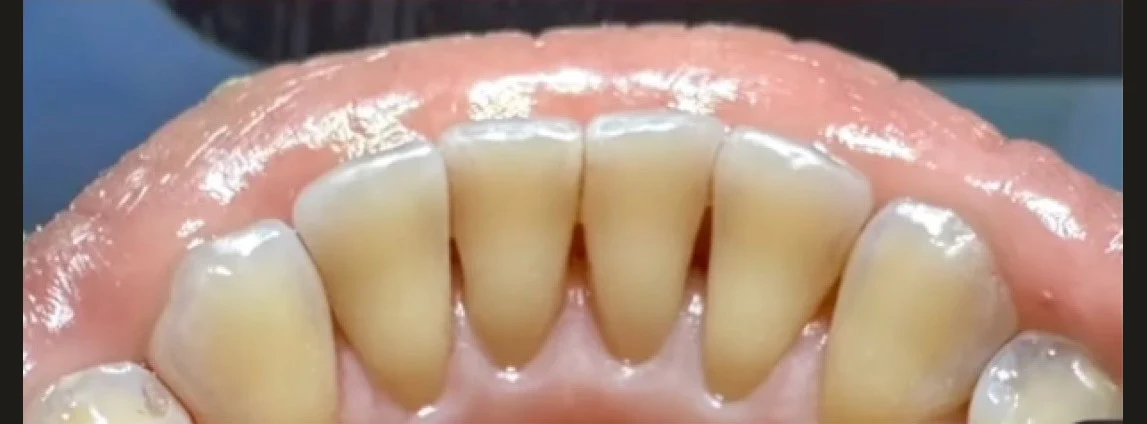 Lower front teeth after treatment