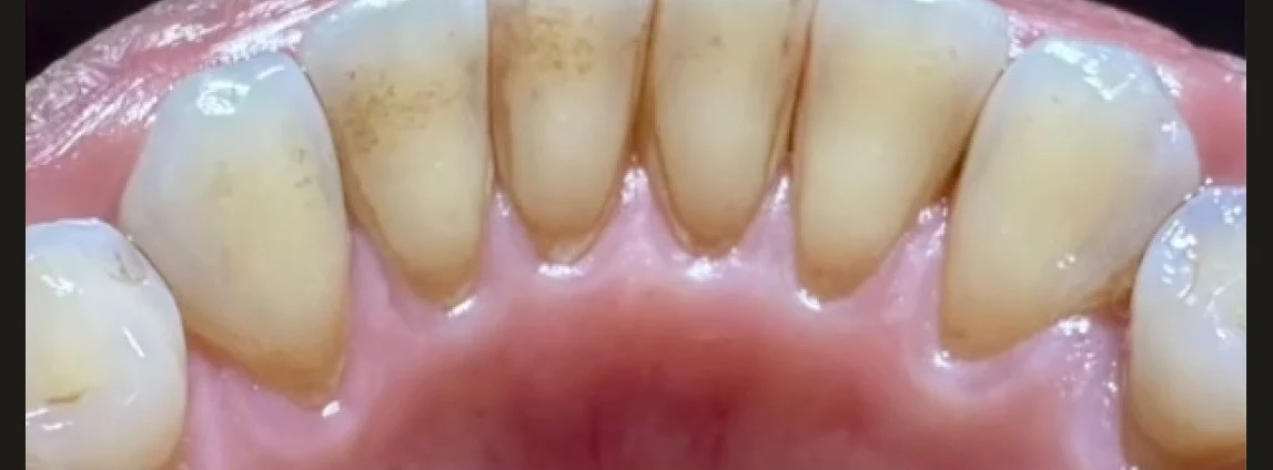 Stained lower front teeth before treatment