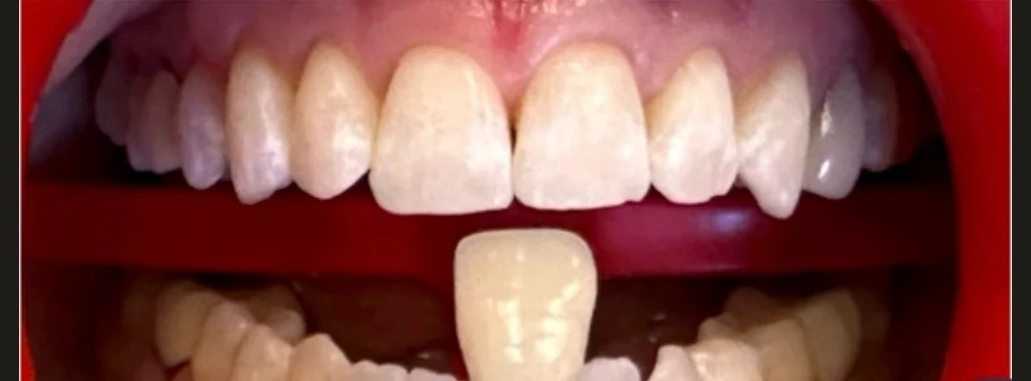Front teeth after whitening, with a shade guide tab for comparison