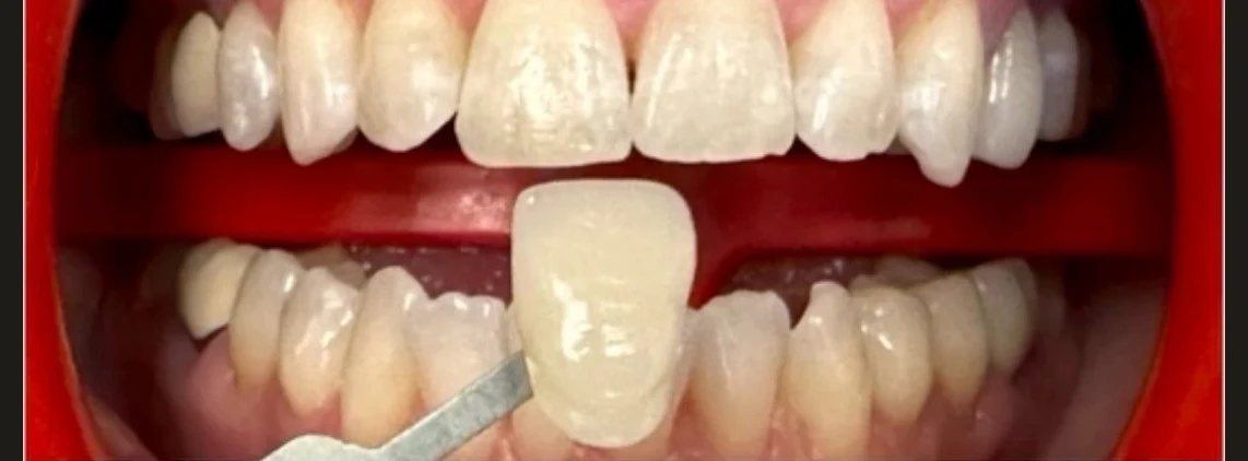 Front teeth before whitening, with a shade guide tab for comparison