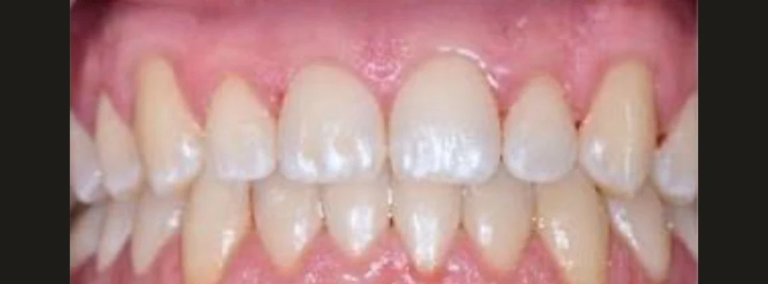 Upper and lower teeth after treatment