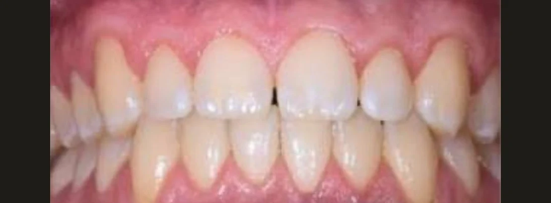 Upper and lower teeth with small gaps before treatment
