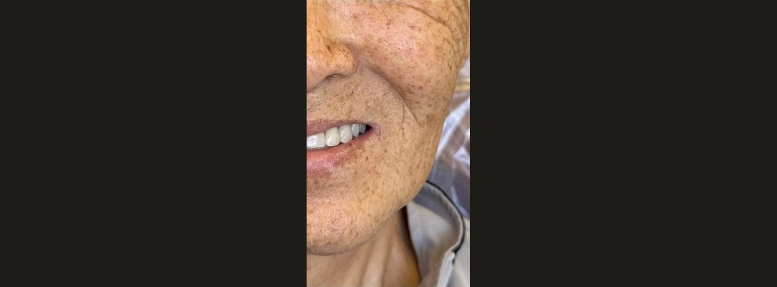 Older patient's smile after missing teeth were replaced