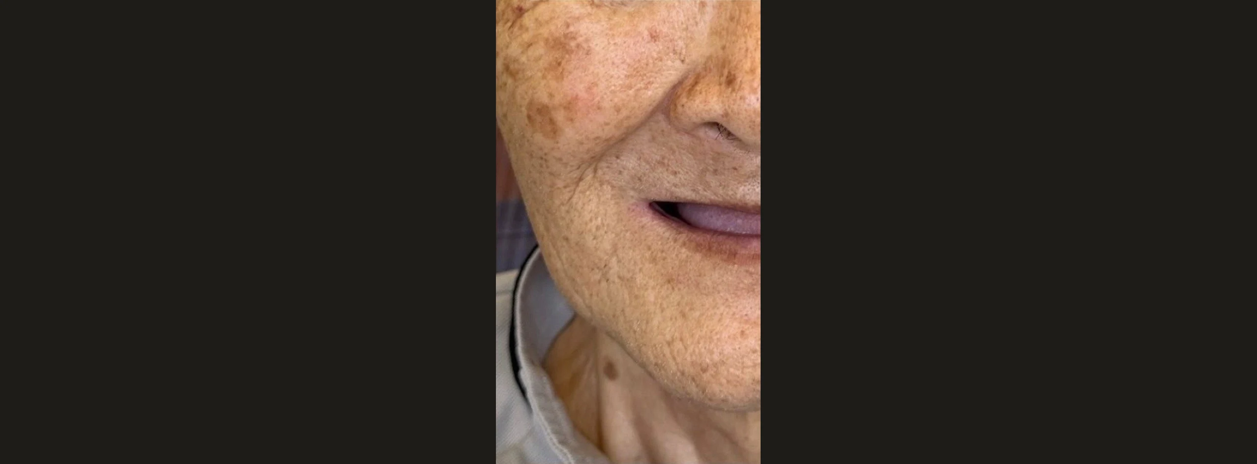 Older patient's smile with missing teeth before treatment