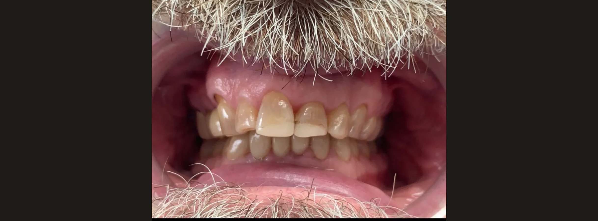 Patient's worn, uneven upper teeth before treatment