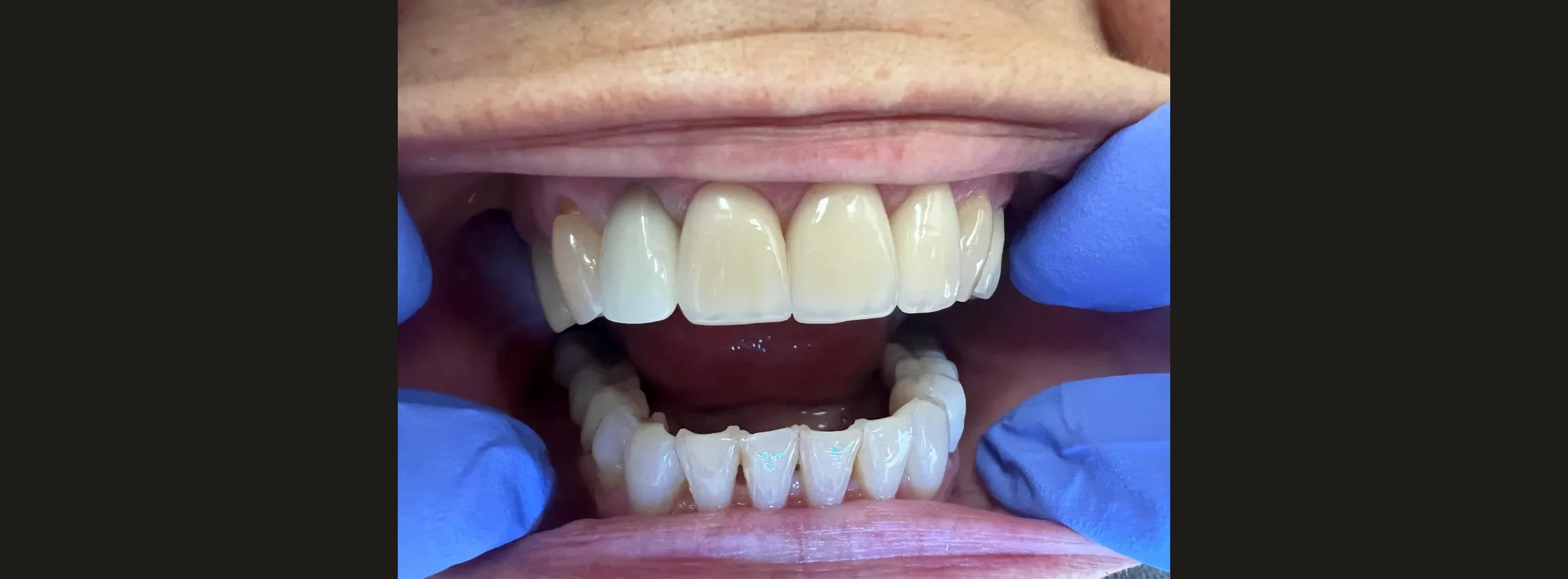 Restored upper front teeth after treatment