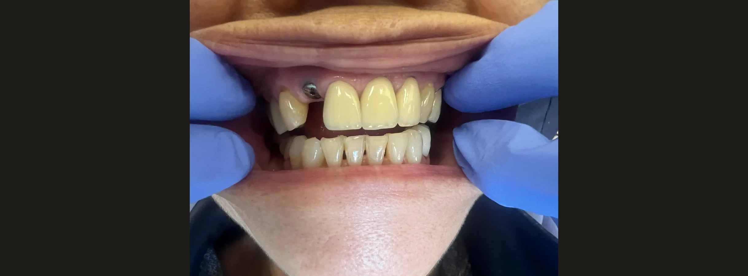 Upper front teeth with a gap before treatment