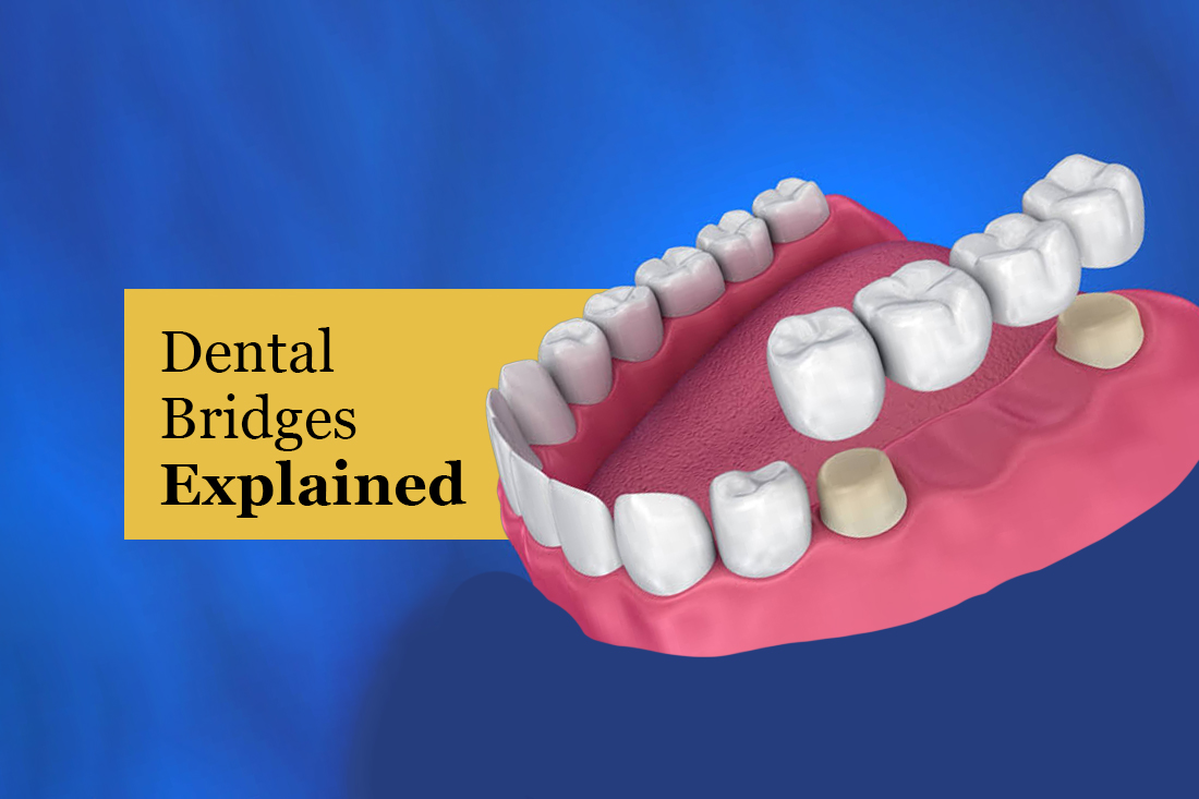 Illustration of a three-unit dental bridge being placed over two prepared teeth, under the title Dental Bridges Explained