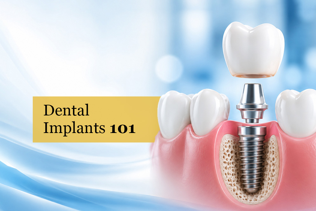 Illustration of an implant post, abutment and crown placed between two natural teeth, under the title Dental Implants 101