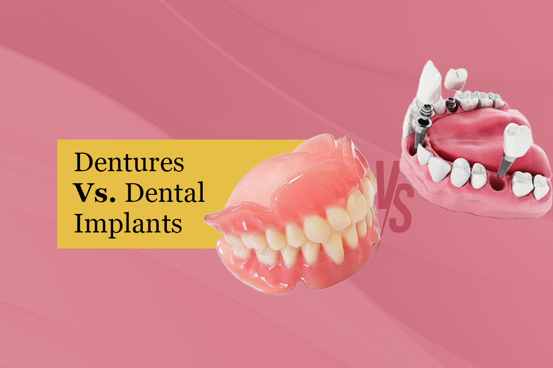 A full upper denture beside an implant-supported lower model, under the title Dentures vs. Dental Implants