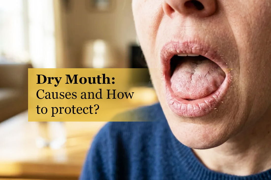 Woman with an open mouth showing a dry tongue and lips, under the title Dry Mouth: Causes and How to Protect