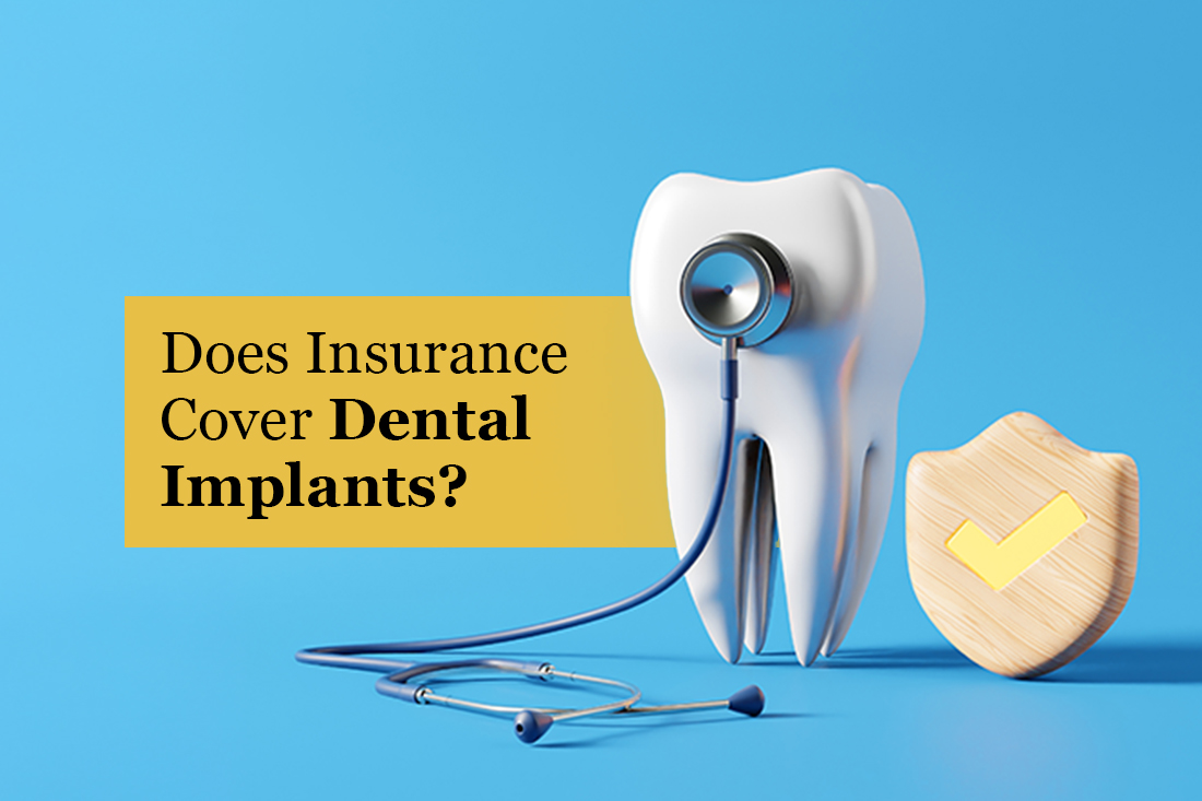 Model tooth with a stethoscope and a checkmark shield on a blue background, under the title Does Insurance Cover Dental Implants?