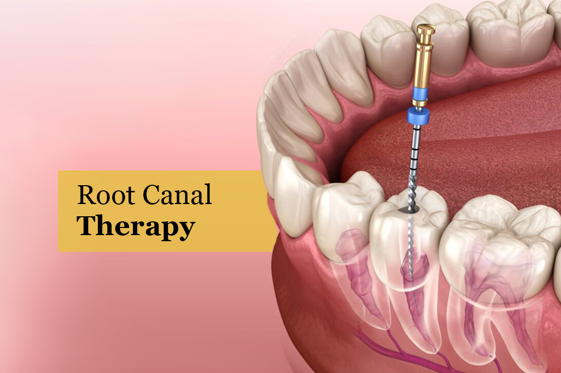 Illustration of a root canal file cleaning the canals inside a molar, under the title Root Canal Therapy