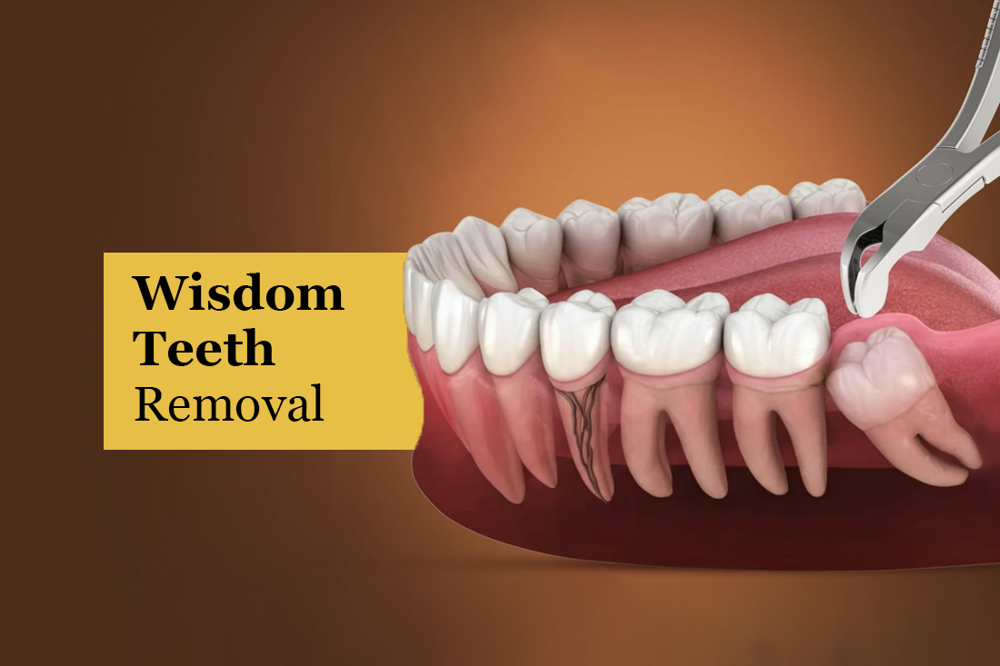 Illustration of forceps removing an impacted wisdom tooth at the back of the jaw, under the title Wisdom Teeth Removal