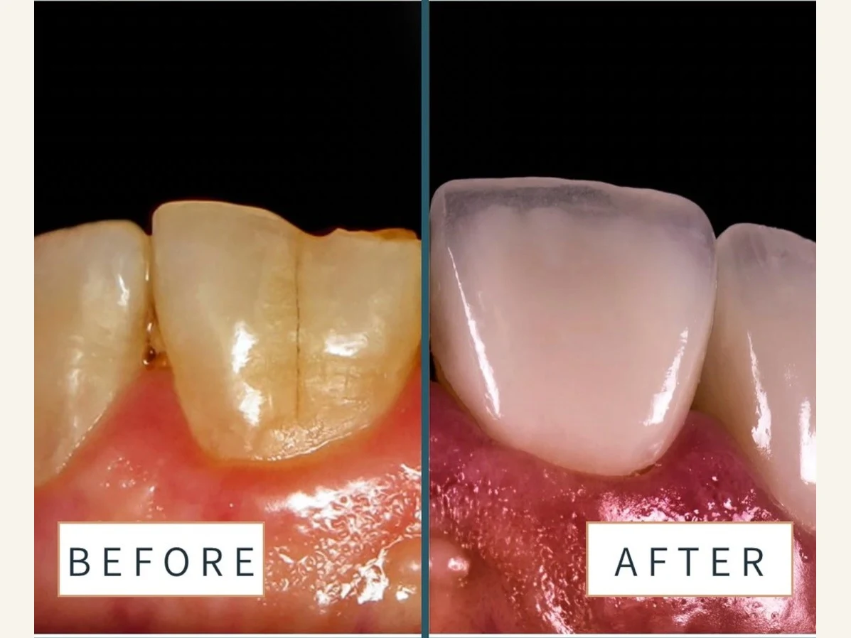 Single front tooth before and after a porcelain crown, labeled before and after