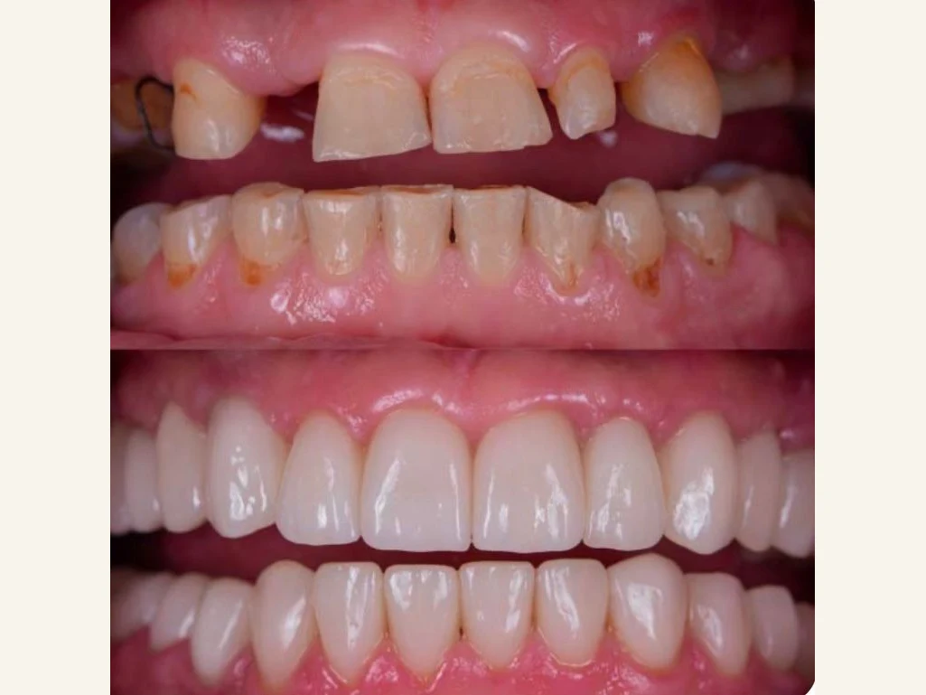 Worn, uneven teeth before and restored, even teeth after a full smile rehabilitation