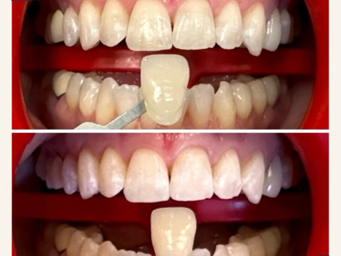 Shade guide held against a patient's teeth before and after whitening