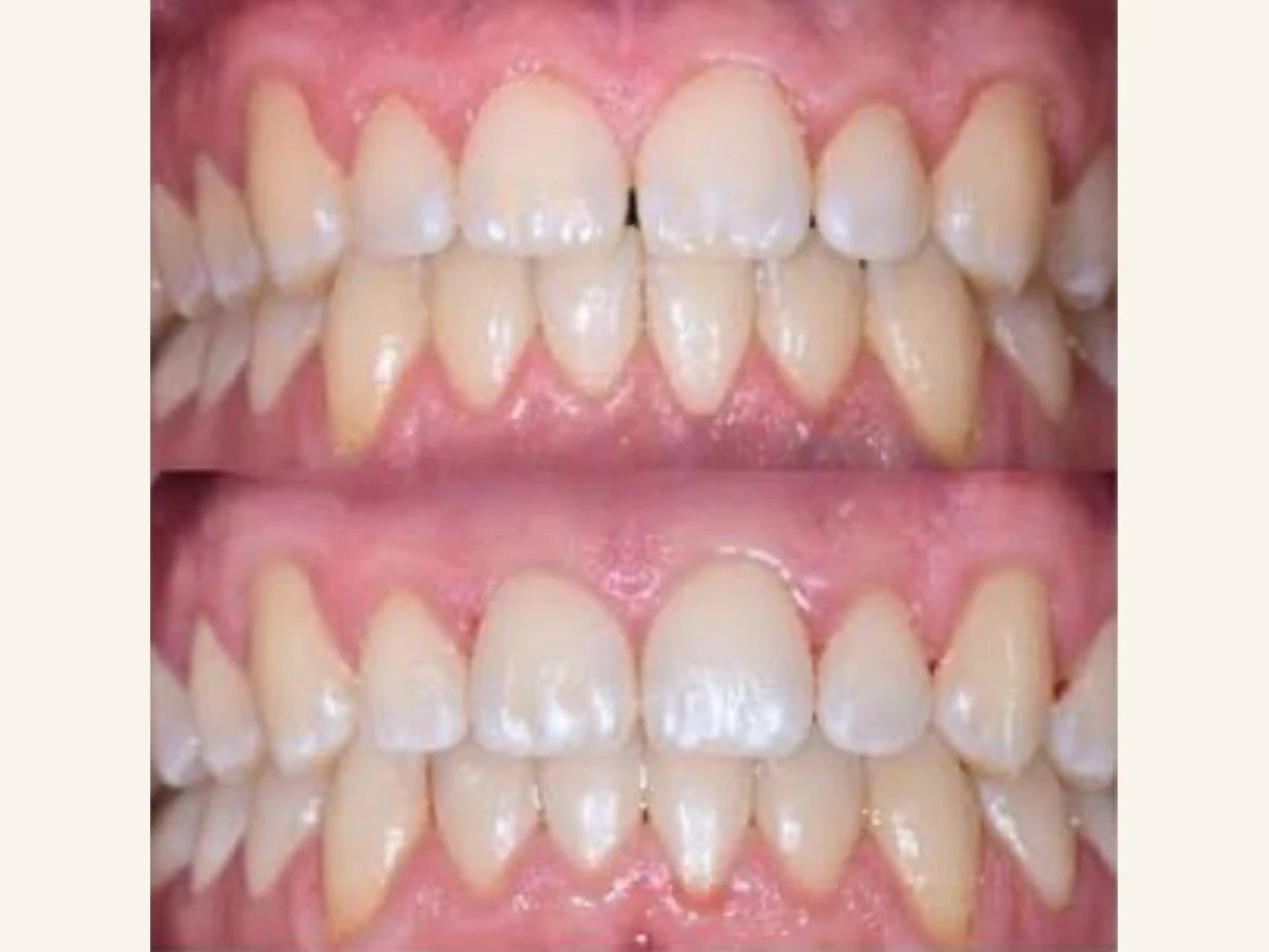 Close-up of a patient's even, natural-looking teeth after treatment