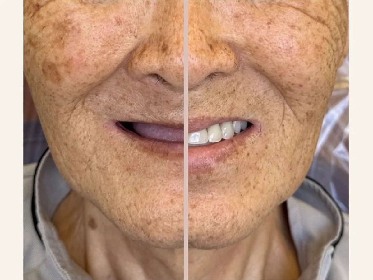 Before and after smile of an older patient whose missing teeth were replaced