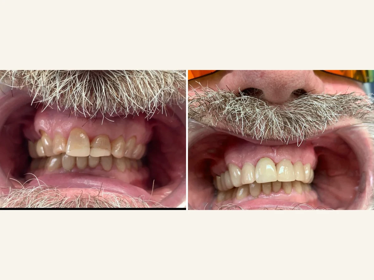 Patient's upper teeth before and after restorative treatment