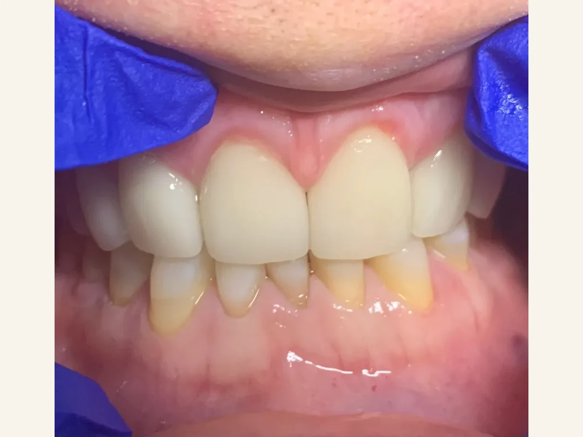 Restored upper front teeth after cosmetic treatment