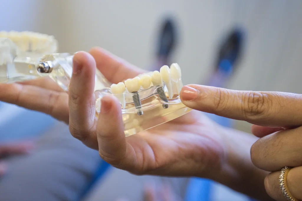 Close-up of a dental implant model held in an open hand